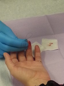 I guess if there is any downside it was that the installation and healing was a bit of a pain. 